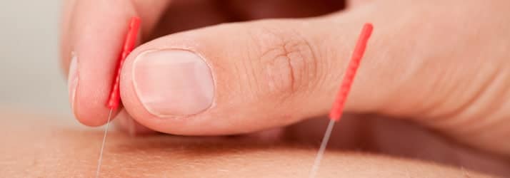 Acupuncture in Naperville IL Acupuncture in Naperville IL